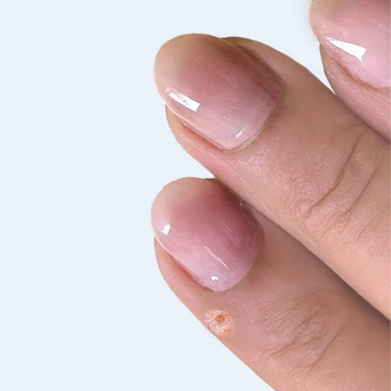 Teinture anti-verrues 