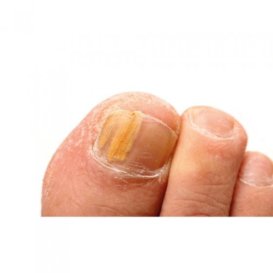 Crème antifongique pour les (ongles des) pieds 
