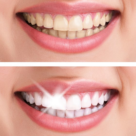 Tandenpolijster Spin White 