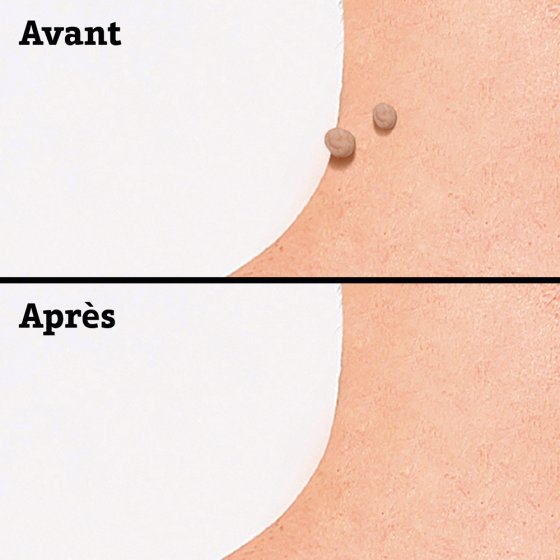 Wratten-verwijderpads 