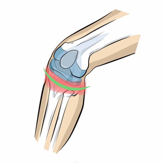 Kniebandage voor de knieschijfpees 